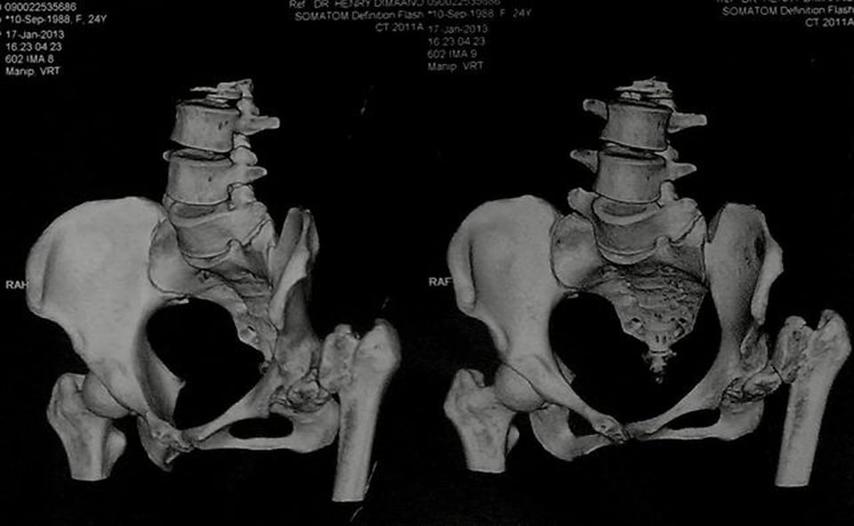 Total Hip Arthroplasty for a neglected Slipped Capital Femoral Epiphysis
