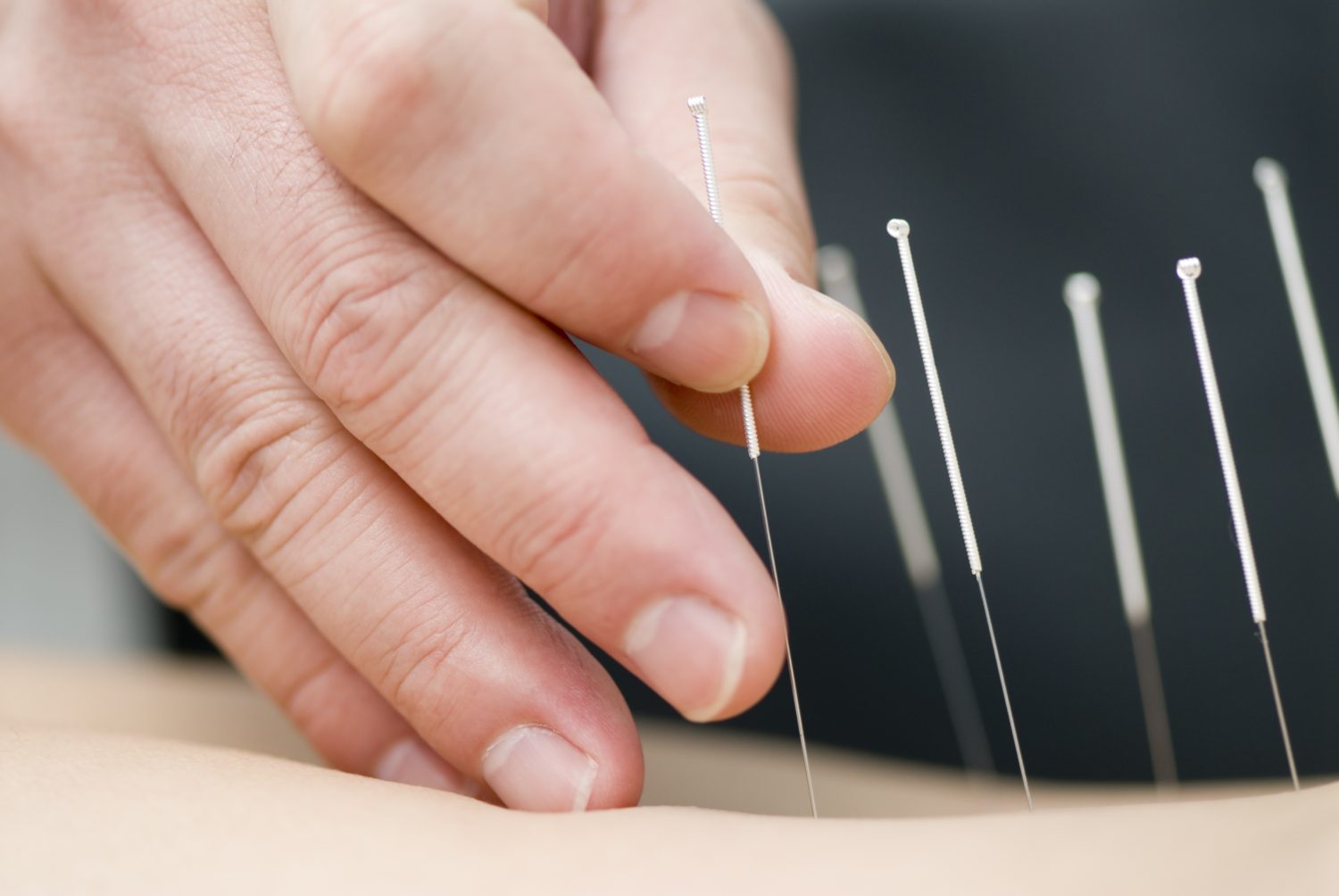 FDA proposes that doctors learn about acupuncture for pain management