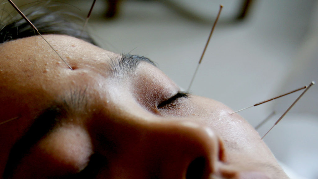 FDA suggests doctors learn about acupuncture for pain management