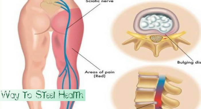 How To Get Rid of Sciatic Nerve Pain At Home – Way to Steel Health