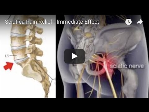 Sciatica Pain Relief — Immediate Effect