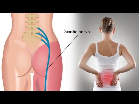 3 Easy Exercises for Sciatica Pain Relief | Natural Cures