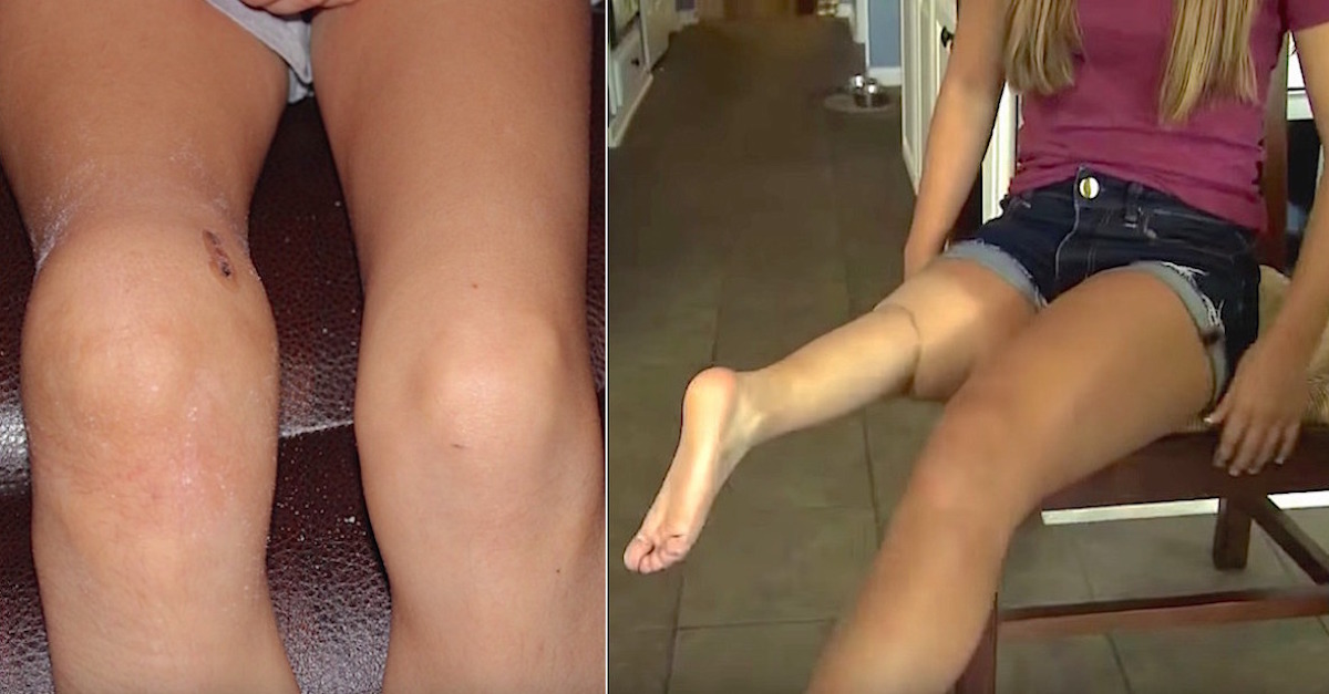 9-Year-Old Notices Sharp Pain In Her Right Knee, Now That One Leg Is Completely Backward
