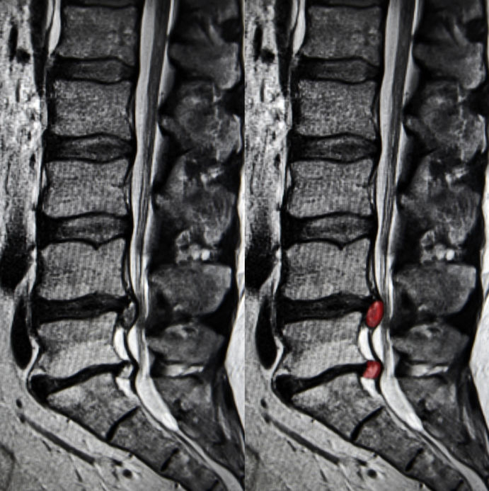 MRI Findings Not Helpful in Determining Herniated Disc-Related Sciatica Treatment