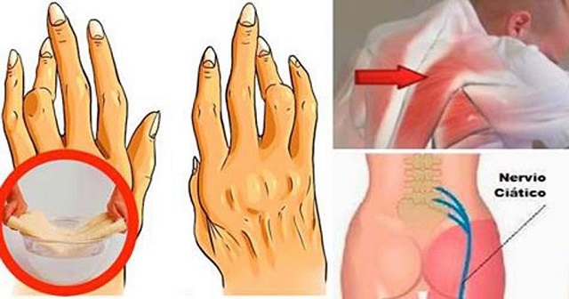 Simple Trick against Sciatica, Back Pain and Arthritis That Is More Effective Than Conventional Treatments