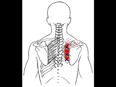 Pain Between the Shoulder Blades from Rhomboid Muscle Trigger Points: Referred Pain Patterns