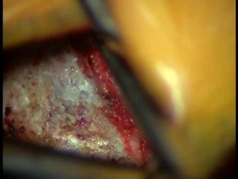 Video of L5-S1 Surgery Lumbar Microdiscectomy | Low Back Pain Surgery |Colorado Spine Surgeon