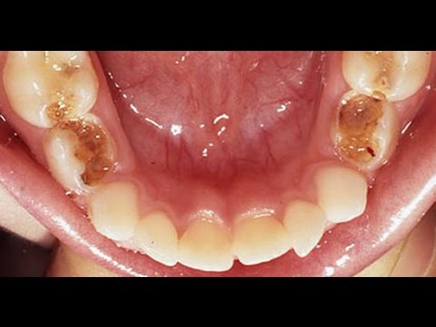 Kill Tooth Pain Nerve In 3 Seconds Permanently With This Tooth ache remedy