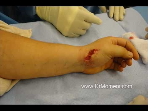 Thumb Arthroplasty (Arthritis Surgery Base of Thumb CMC Joint)