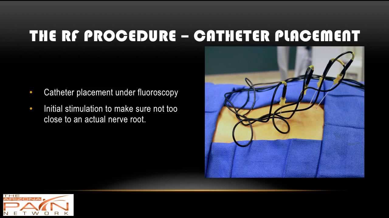 Radiofrequency Ablation Procedure Overview for Pain Management