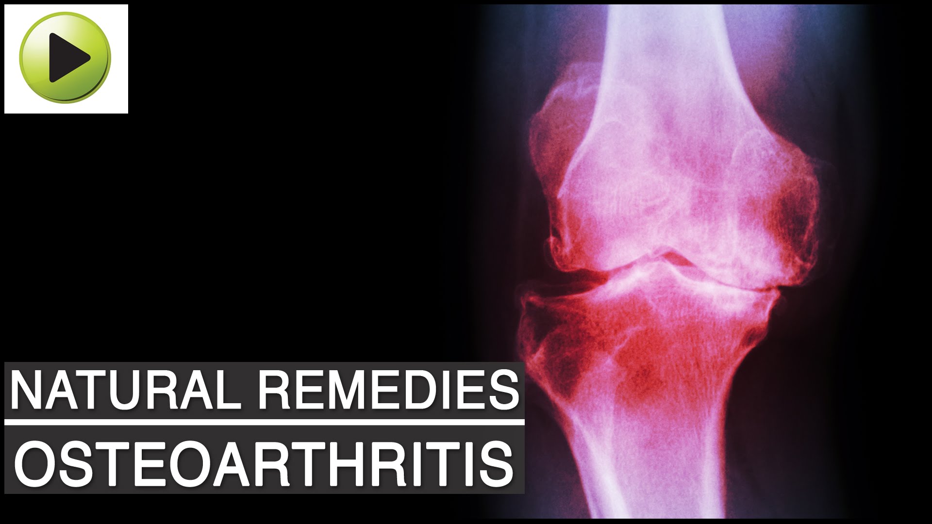 Aches & Pains – Osteoarthritis (Arthritis or Joint Pain) – Natural Ayurvedic Home Remedies