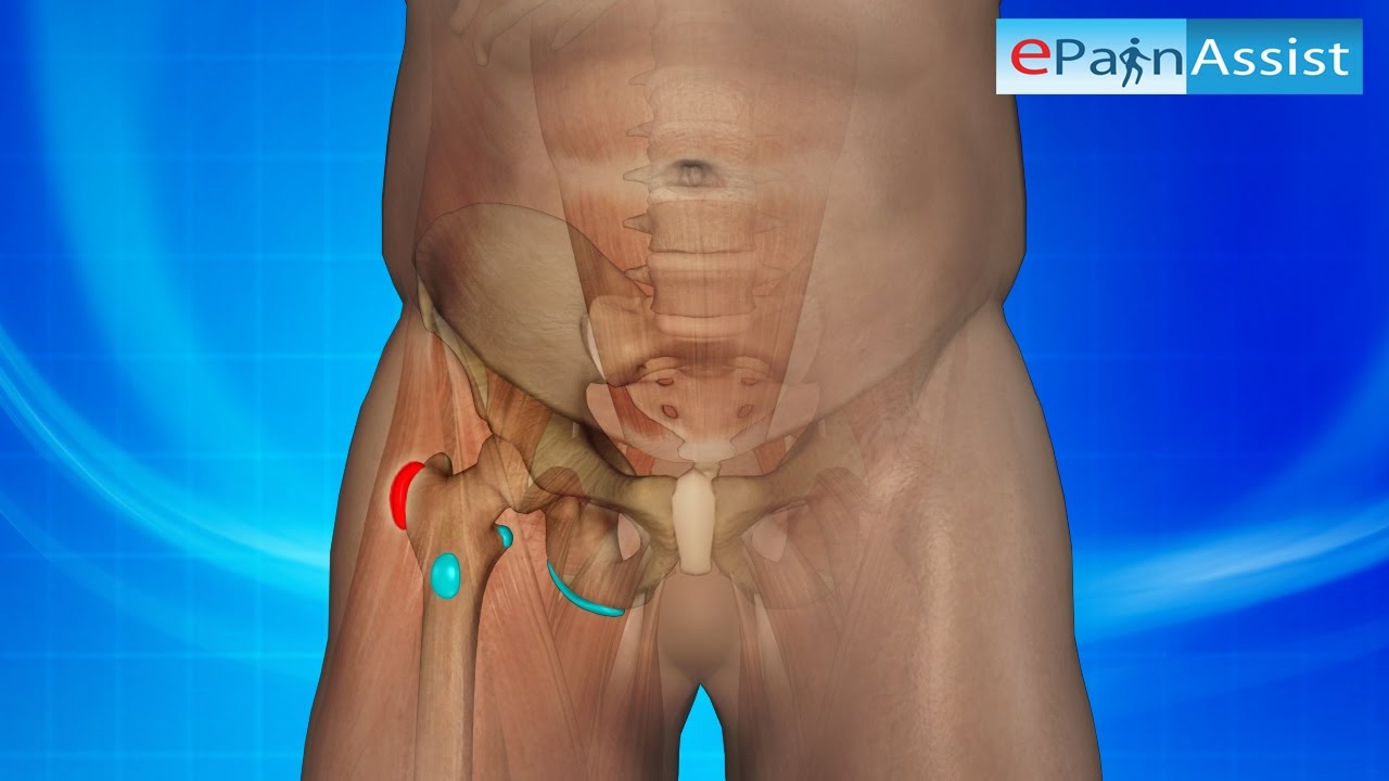 Hip Bursitis 3D Video: Watch How it is Caused, Know Its Treatment, PT, Symptoms