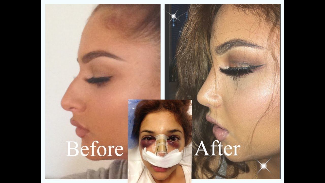 NOSE JOB EXPERIENCE – Doctor, Price, Pain, Recovery etc.