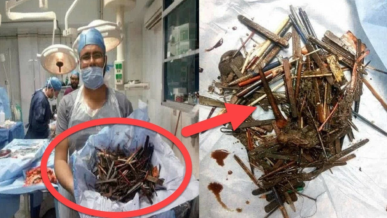 OMG… Woman Suffers Severe Abdominal Pain, This Is What Doctors Found Inside Her Stomach!