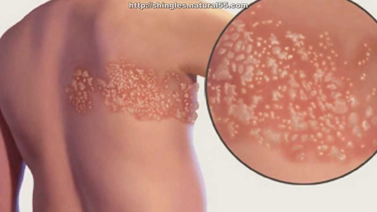 Natural Treatment For Shingles Pain Relief | Cure Shingles (Herpes Zoster) At Home Fast