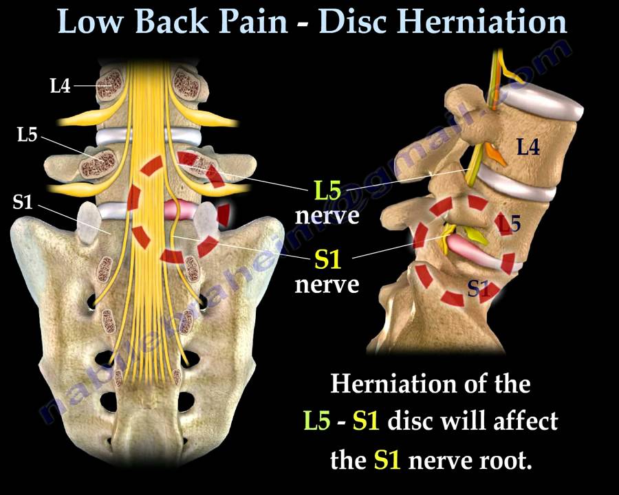 Low Back Pain –   Disc  Herniation ,Sciatica  – Everything You Need To Know – Dr. Nabil Ebraheim
