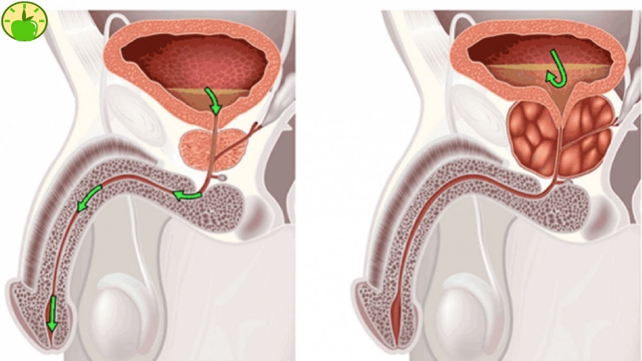 9 NATURAL CURES FOR ENLARGED PROSTATE TO SHRINK IT WITH NO PAIN!!