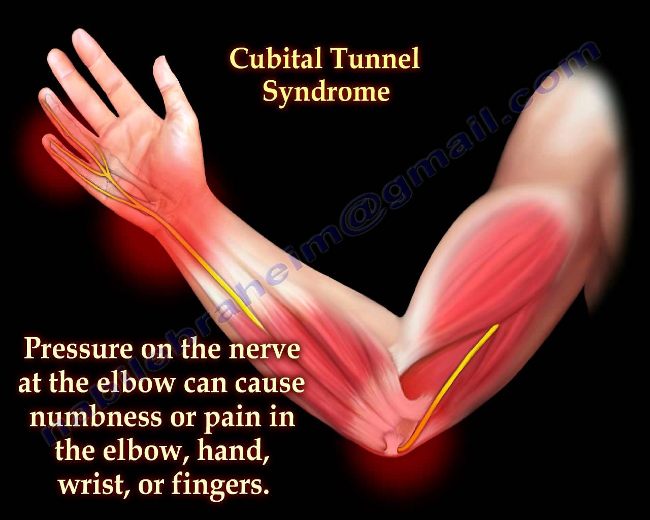 Cubital Tunnel Syndrome Ulnar Nerve Entrapment – Everything You Need To Know – Dr. Nabil Ebraheim