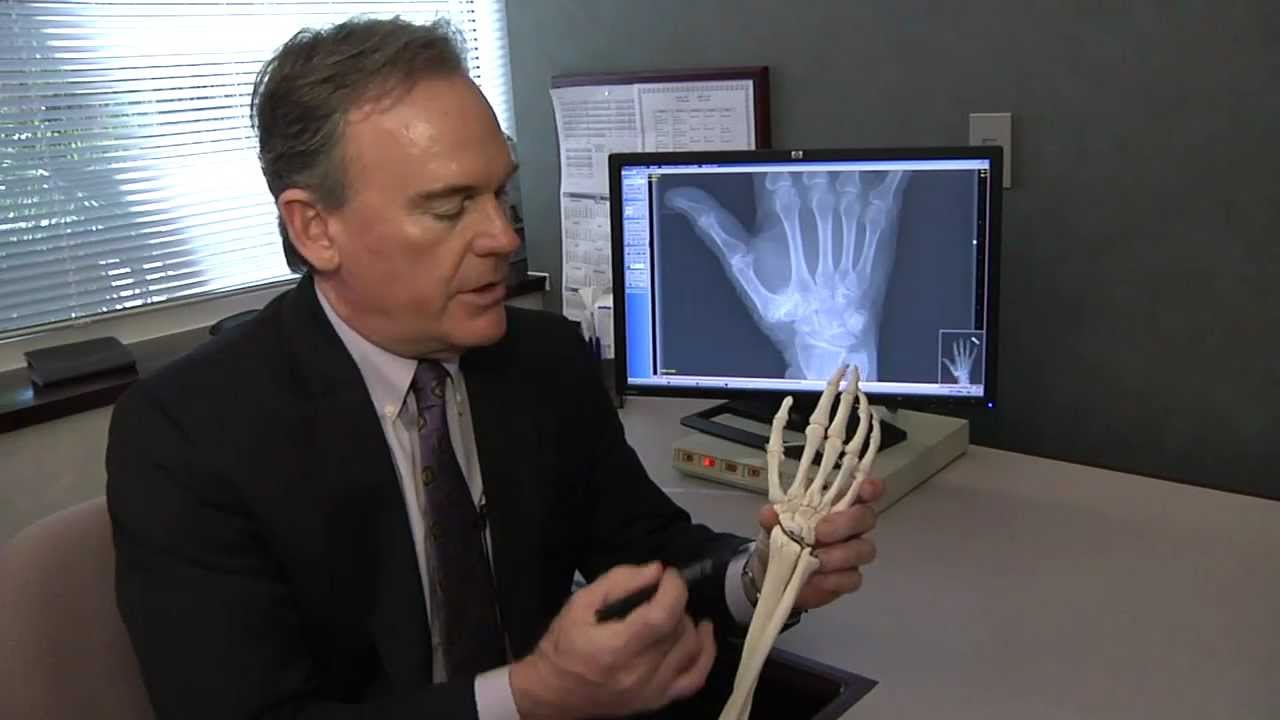 Treating Basal Thumb Joint Arthritis – Mayo Clinic