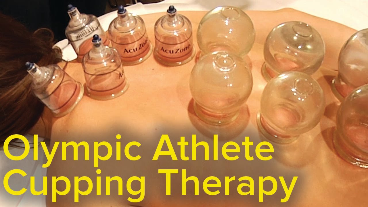 Chinese Cupping Therapy – Michael Phelps Olympics Bruise Mystery Solved | Pain Relief and Therapy