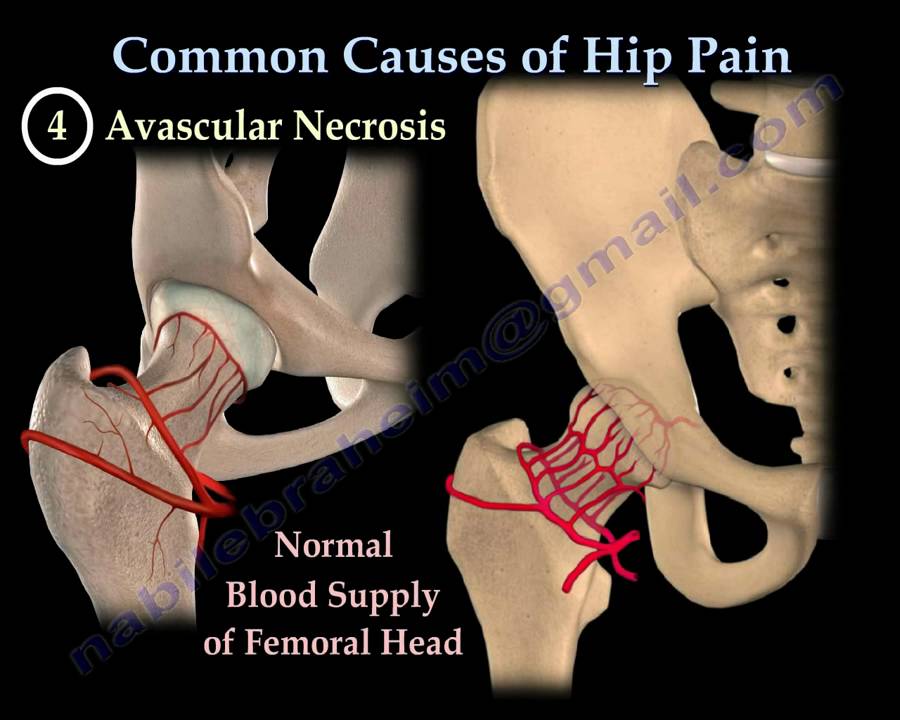 HIP PAIN ,COMMON CAUSES- Everything You Need To Know – Dr. Nabil Ebraheim