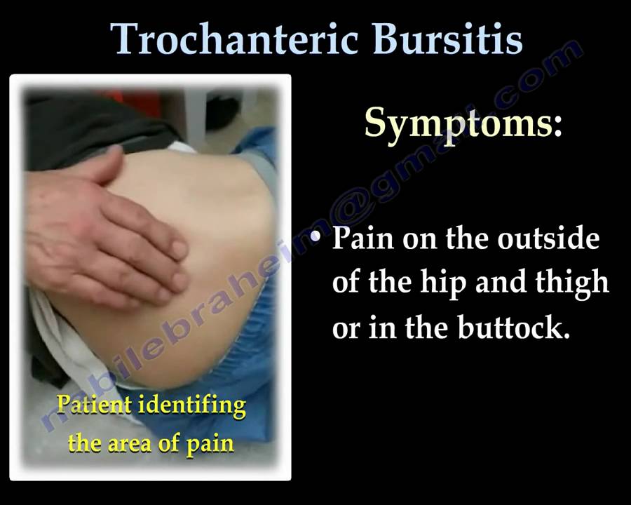 Trochanteric Bursitis , hip bursitis- Everything You Need To Know – Dr. Nabil Ebraheim