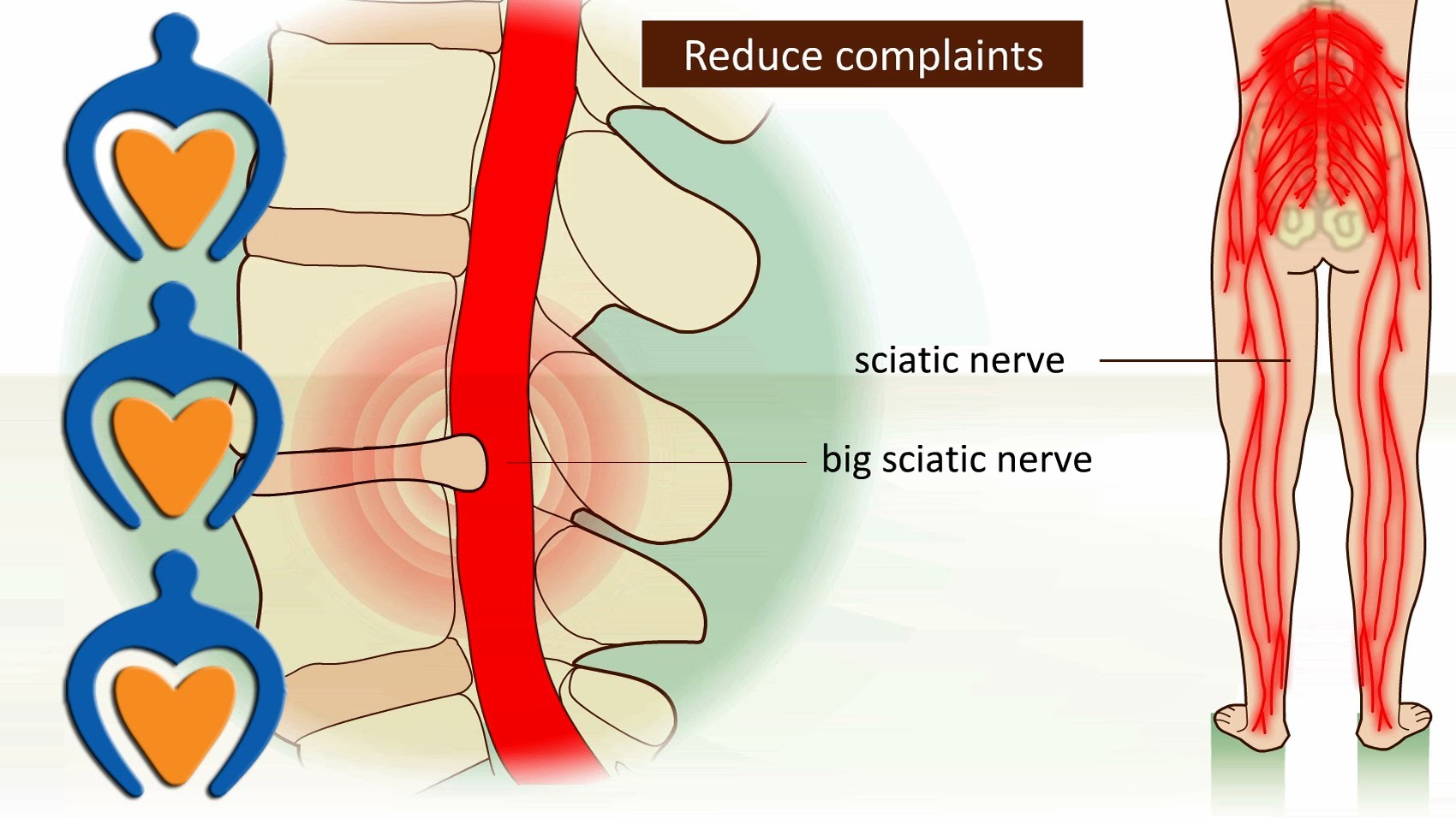 Lower back pain (a.o. sciatica, herniated disk) – It’s causes, symptoms and treatment.