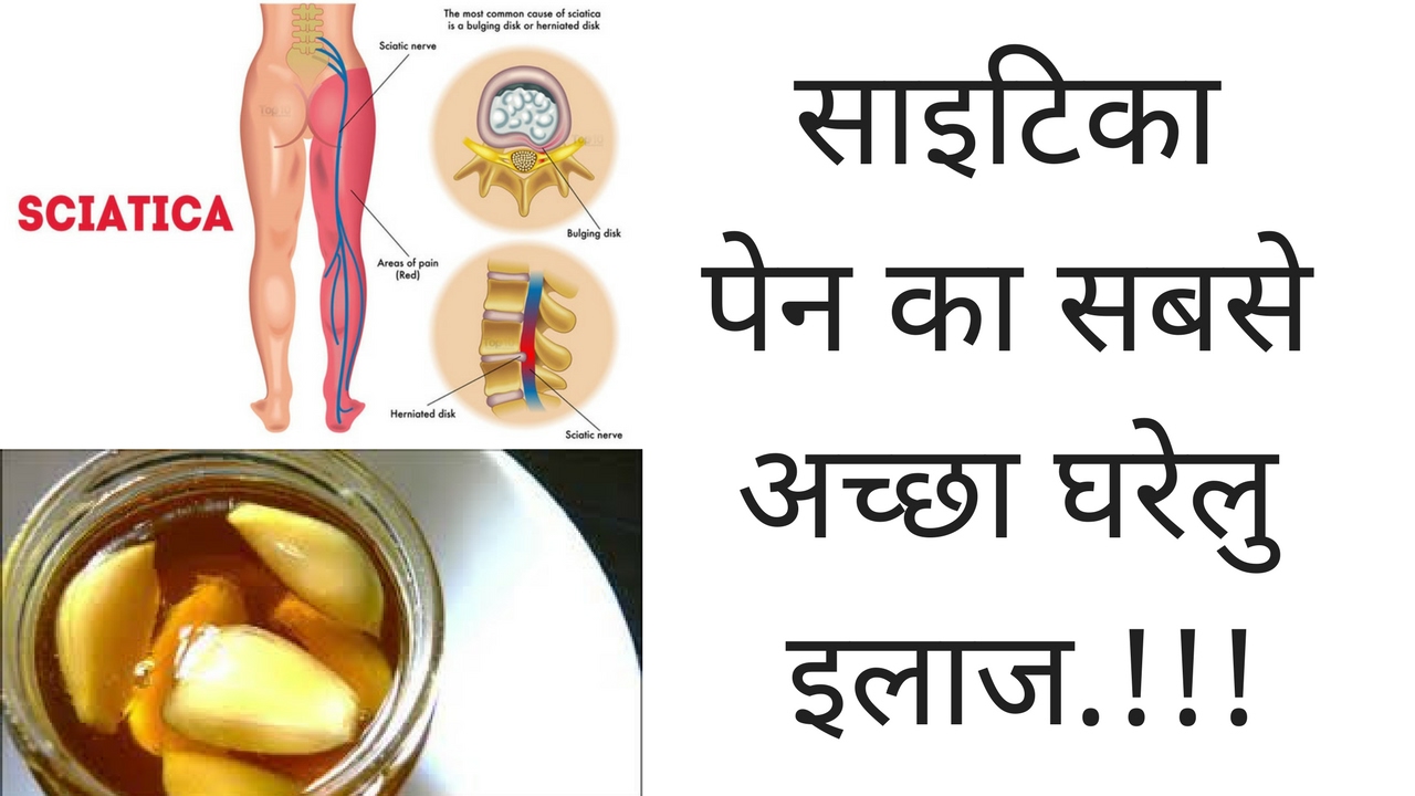 साइटिका पेन का सबसे अच्छा घरेलु इलाज.!!!  Cure Sciatica by Ayurveda Treatment