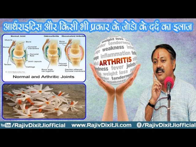 Miraculous Treatment of Arthritis Knee Joint Pain Fever Pain By Rajiv Dixit Ji