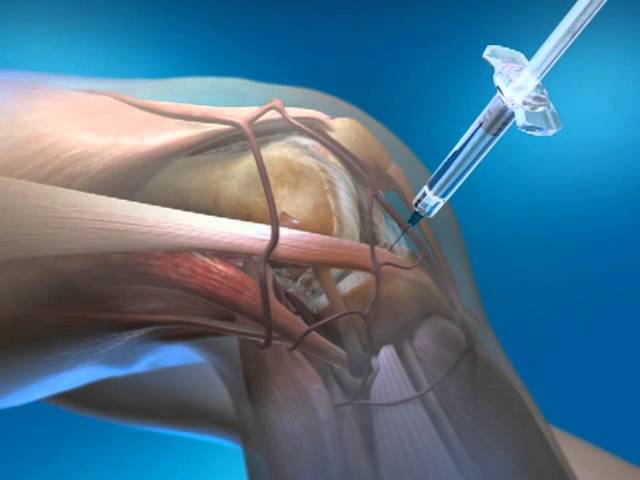 Knee Injection with Euflexxa – Non-surgical Knee Pain Relief