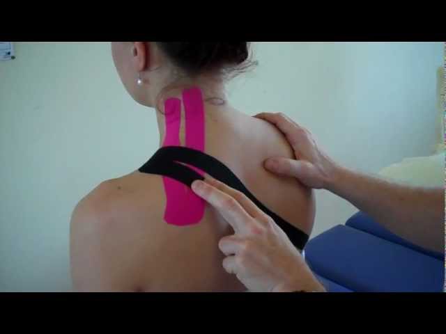How to treat Neck pain – Levator Scapulae / Upper Trapezius Strain using Kinesiology Tape