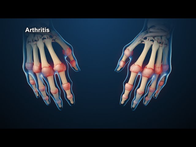 Rheumatoid Arthritis | Nucleus Health